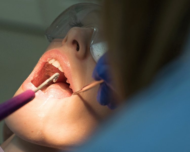 Dental Fillings In Oshawa, ON