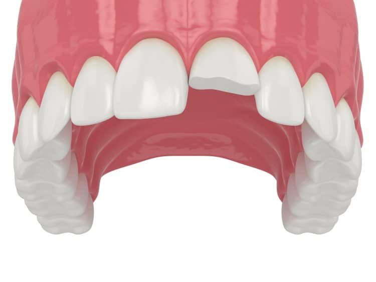 Can a Dentist Fix a Chipped Tooth