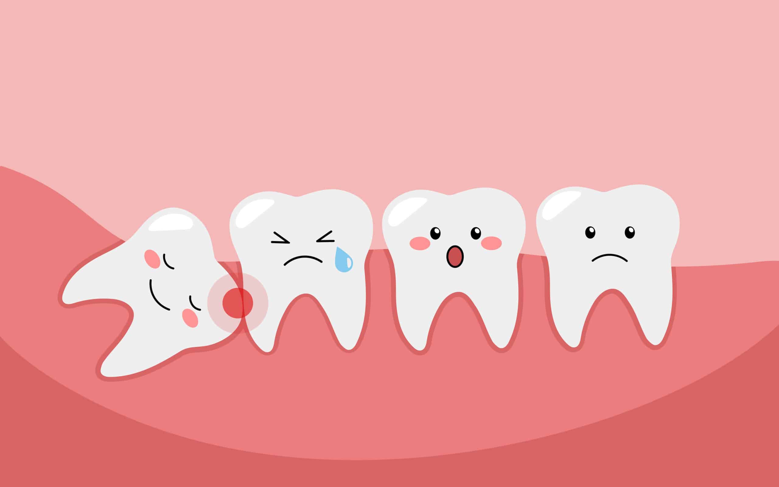 Everything You Need to Know About Wisdom Teeth