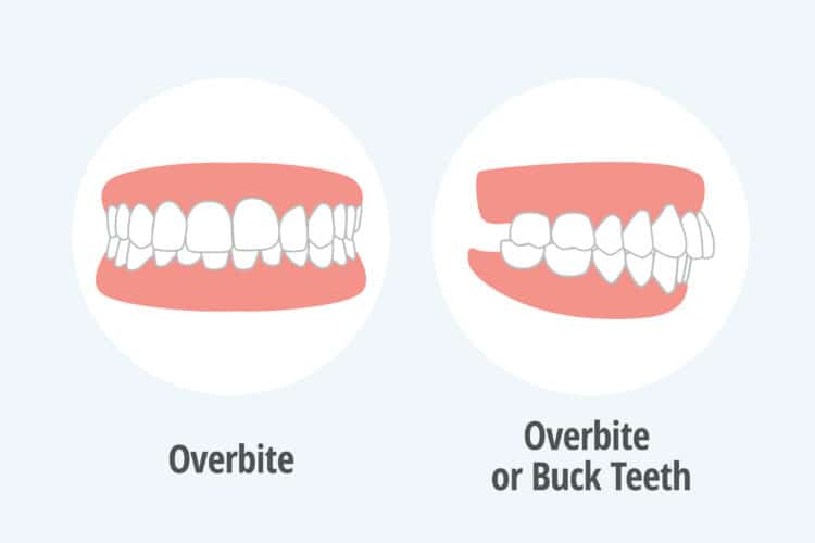 Overbite vs. Buck Teeth: Understanding Causes, Risks, and Treatment Solutions